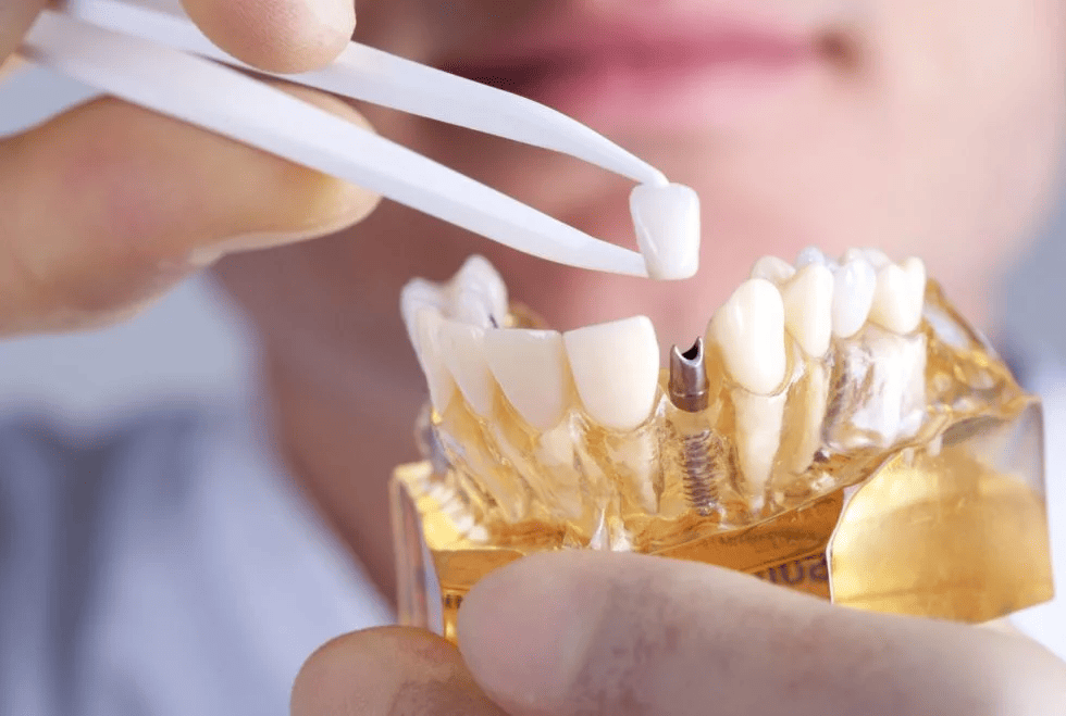 Ventajas estéticas de los implantes dentales